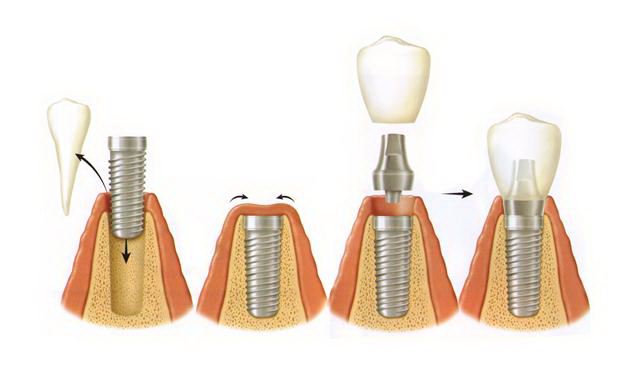 Имплантация зубов в три этапа
